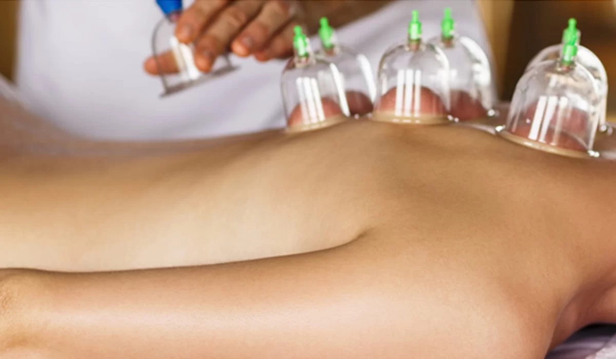 cupping therapy 